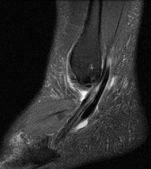 Figure 4 for case Peroneus brevis split tear